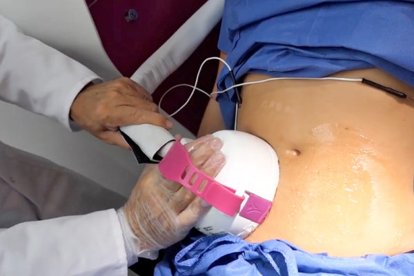 Body recontouring with an non-invasive method